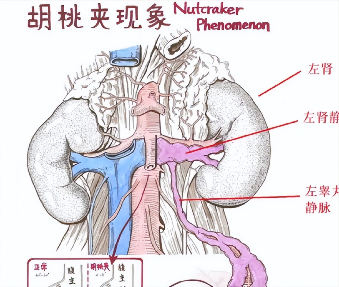 胡桃夹是什么意思（胡桃夹综合征引起的原因）看最鲜网，看新知识-提供各类互联网项目，互联网副业，职场技能课程，股票期货投资, 校园课程，升学考试等有价值的知识看最鲜网，看新知识