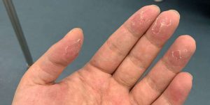 手脱皮是什么原因导致的（手上大量脱皮怎么回事）看最鲜网，看新知识-提供各类互联网项目，互联网副业，职场技能课程，股票期货投资, 校园课程，升学考试等有价值的知识看最鲜网，看新知识