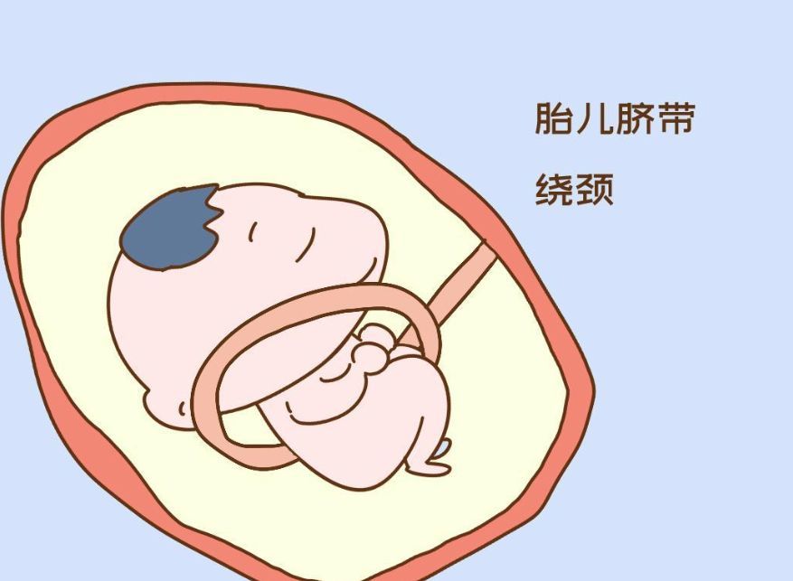 脐带绕颈和睡姿有关吗（孕妇睡姿会导致脐带绕颈吗）看最鲜网，看新知识-提供各类互联网项目，互联网副业，职场技能课程，股票期货投资, 校园课程，升学考试等有价值的知识看最鲜网，看新知识